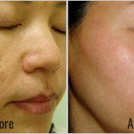 Spectra-Laser-Toning-Before-After-1